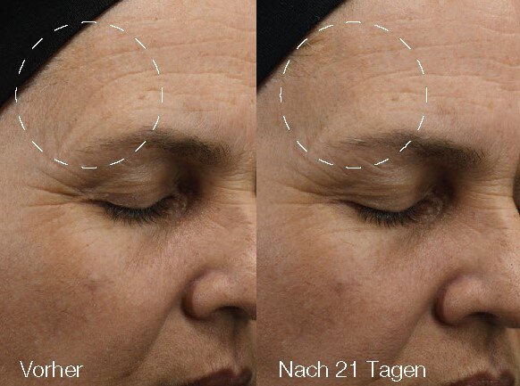 BA Microneedling-1